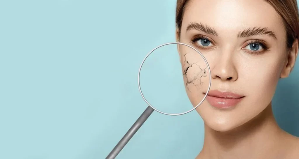 cracked-skin